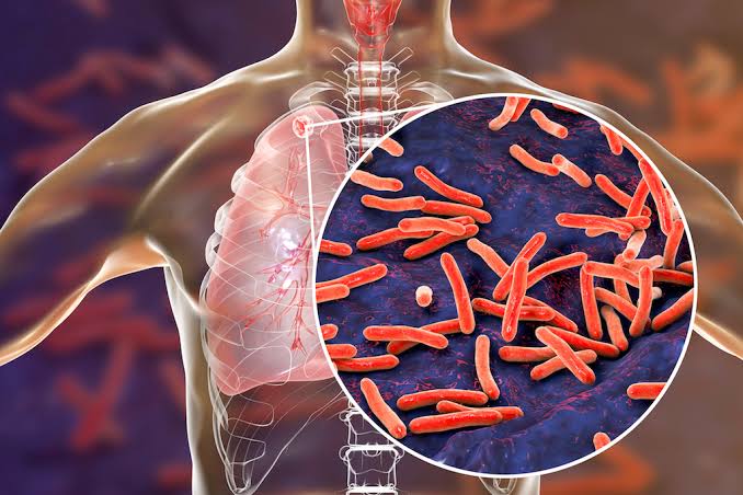 TUBERCULOSIS (TB): IT’S CLOSER THAN YOU THINK   